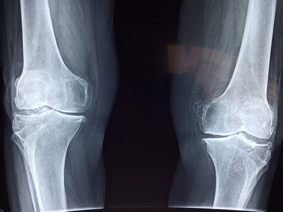 Osteoartrite del ginocchio