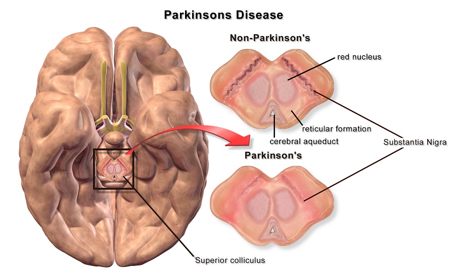 Parkinson e popolazioni neuronali